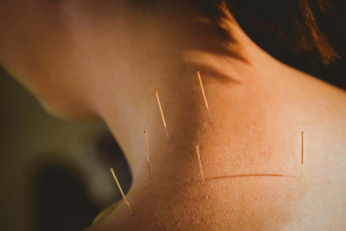 Na co pomaga akupunktura